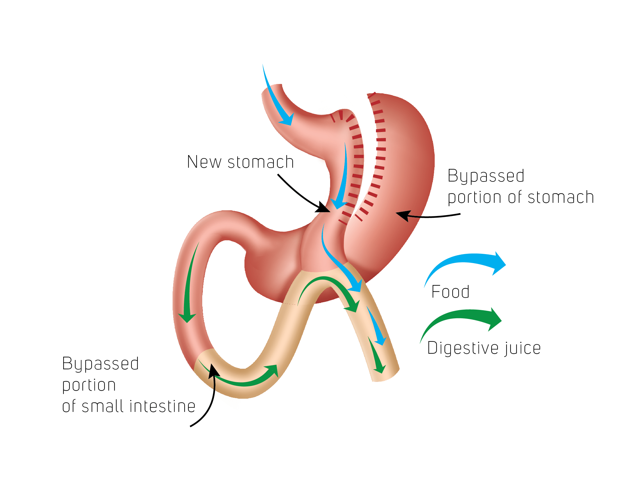 mini gastric bypass OAGB