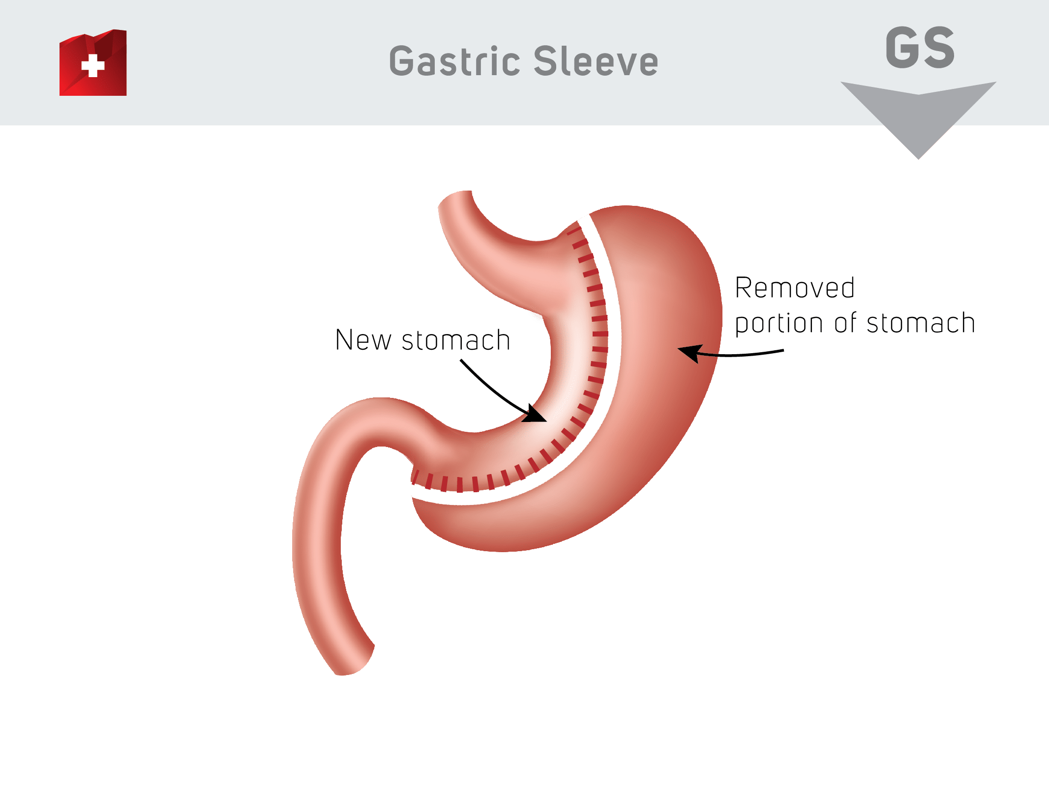 gastric sleeve schema
