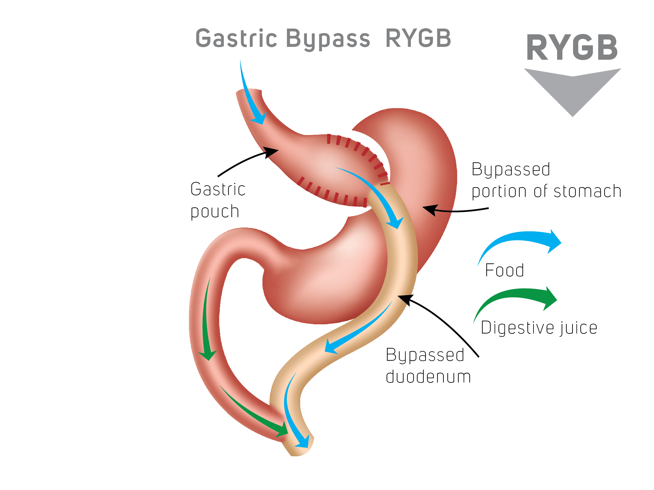 gastric bypass RYGB schema