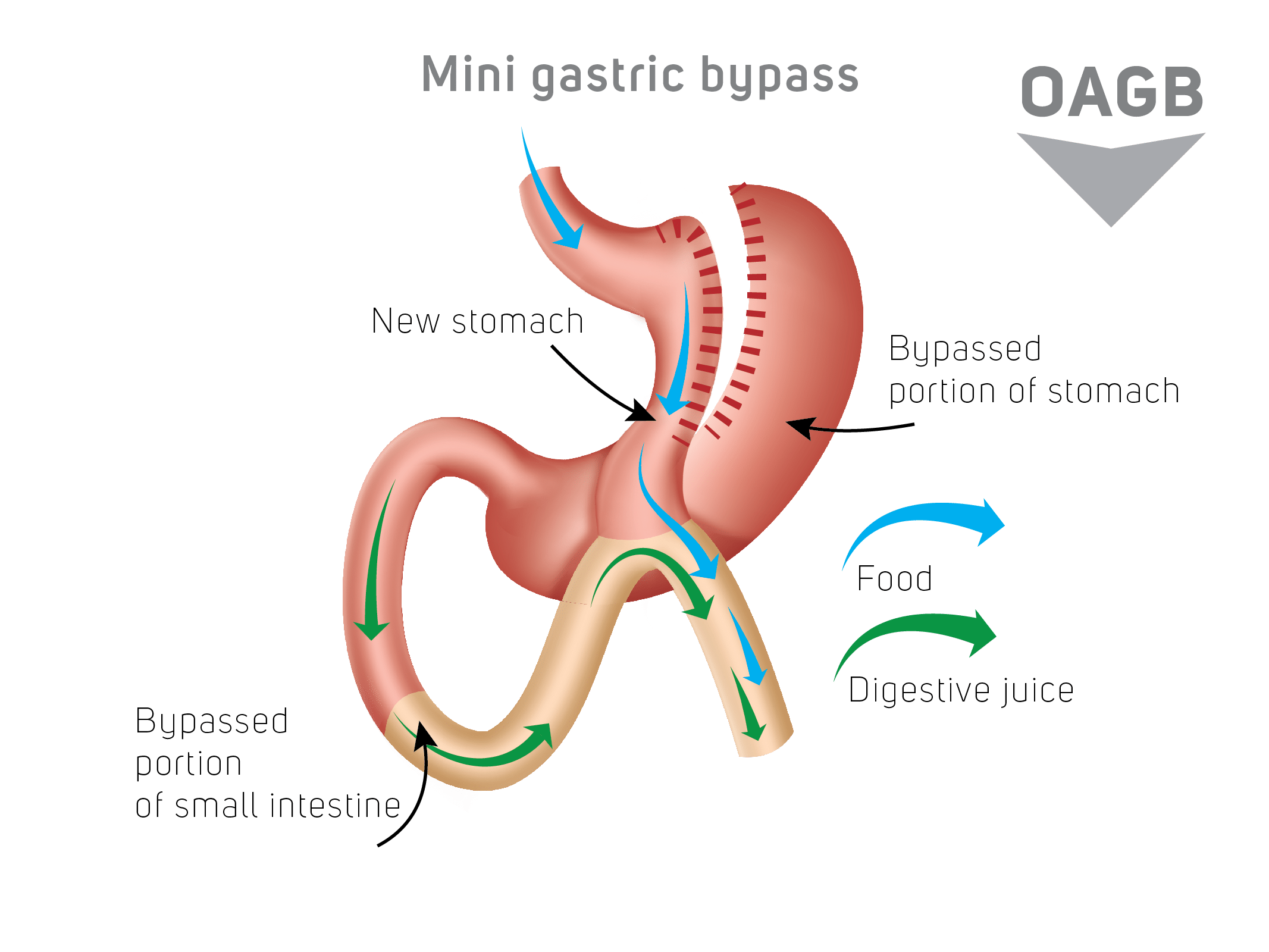 mini gastric bypass schema