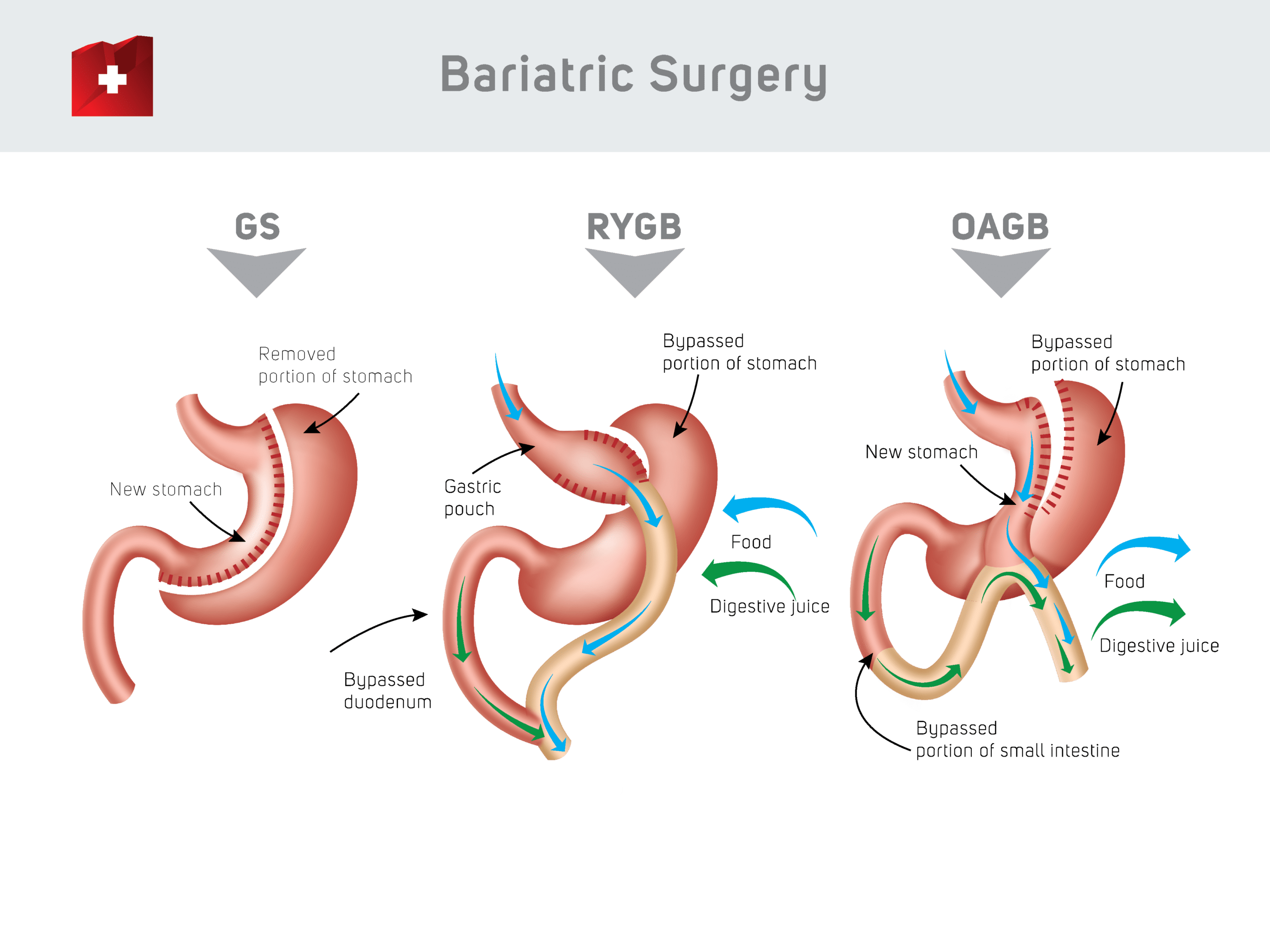 Bariatric Surgery - GS / RYGB / OAGB - procedure