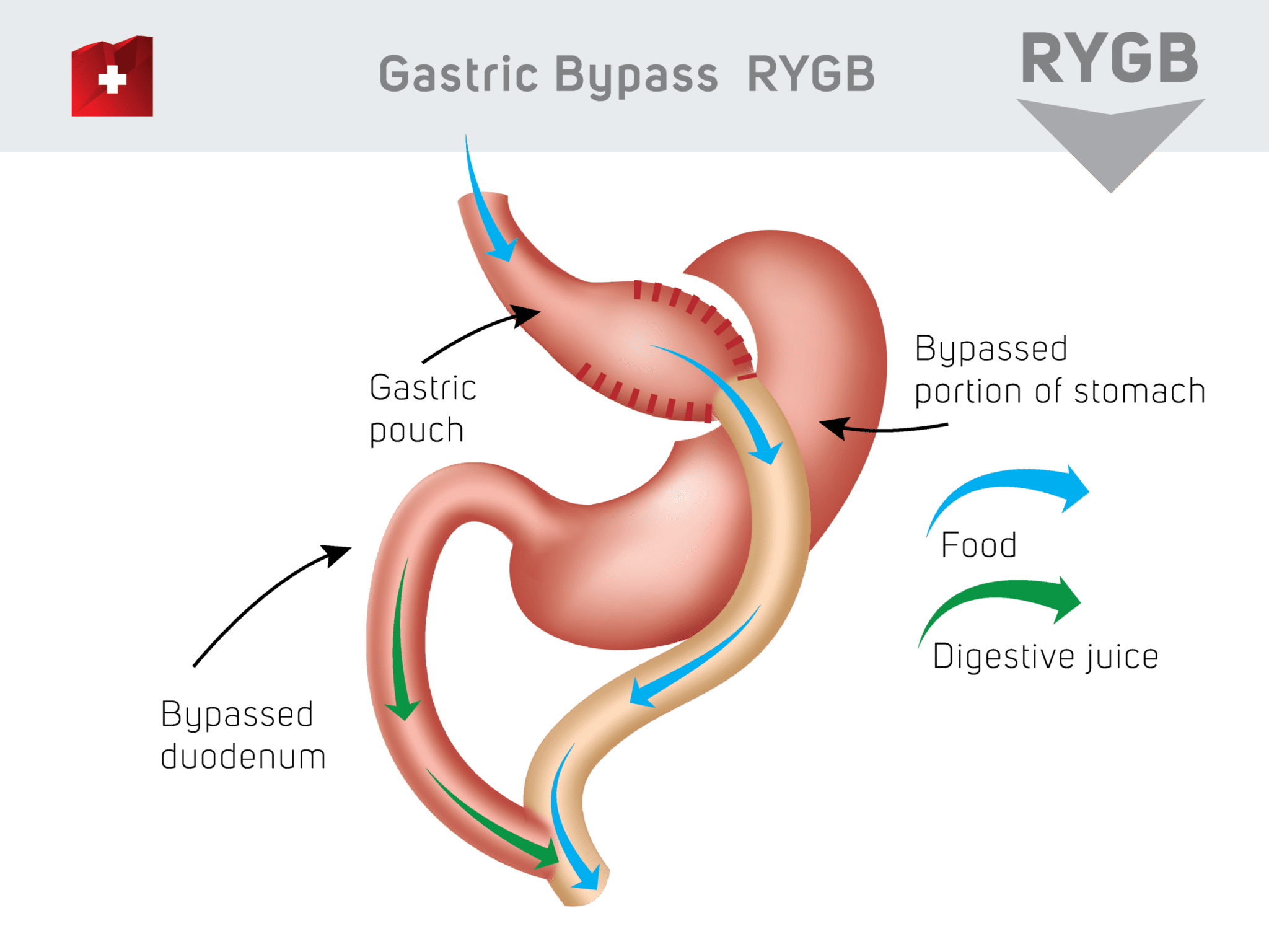 Gastric Bypass Surgery Procedure & Cost In UK
