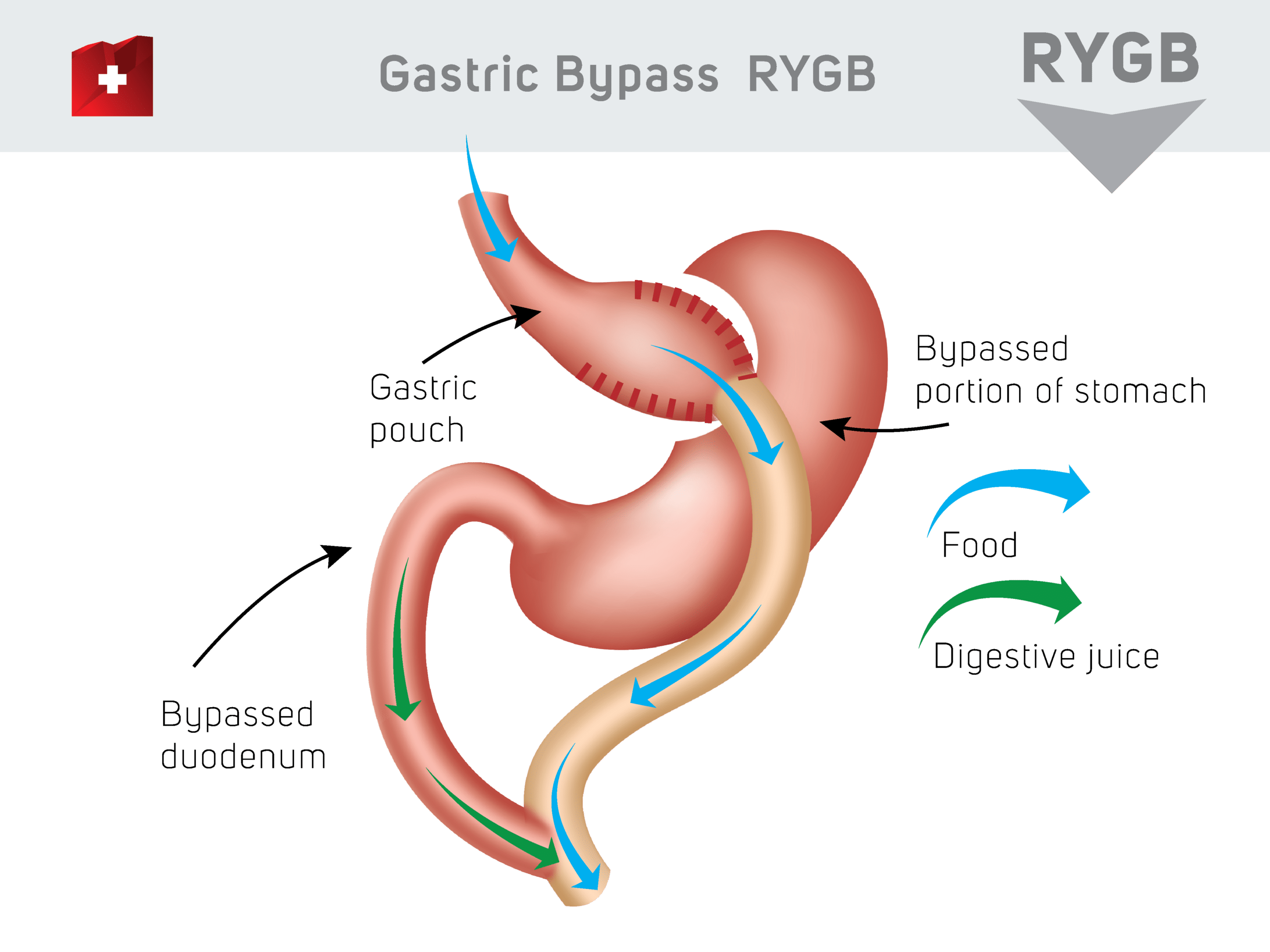 Gastric Bypass RYGB - gastric pouch / baypassed portin of stomach / baypassed doudenum