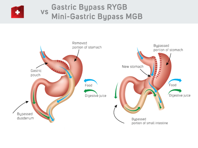 Gastric Bypass vs Mini Gastric Bypass comparasion