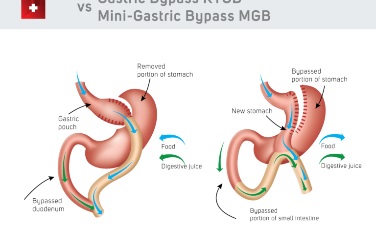 Gastric Bypass vs Mini Gastric Bypass comparasion