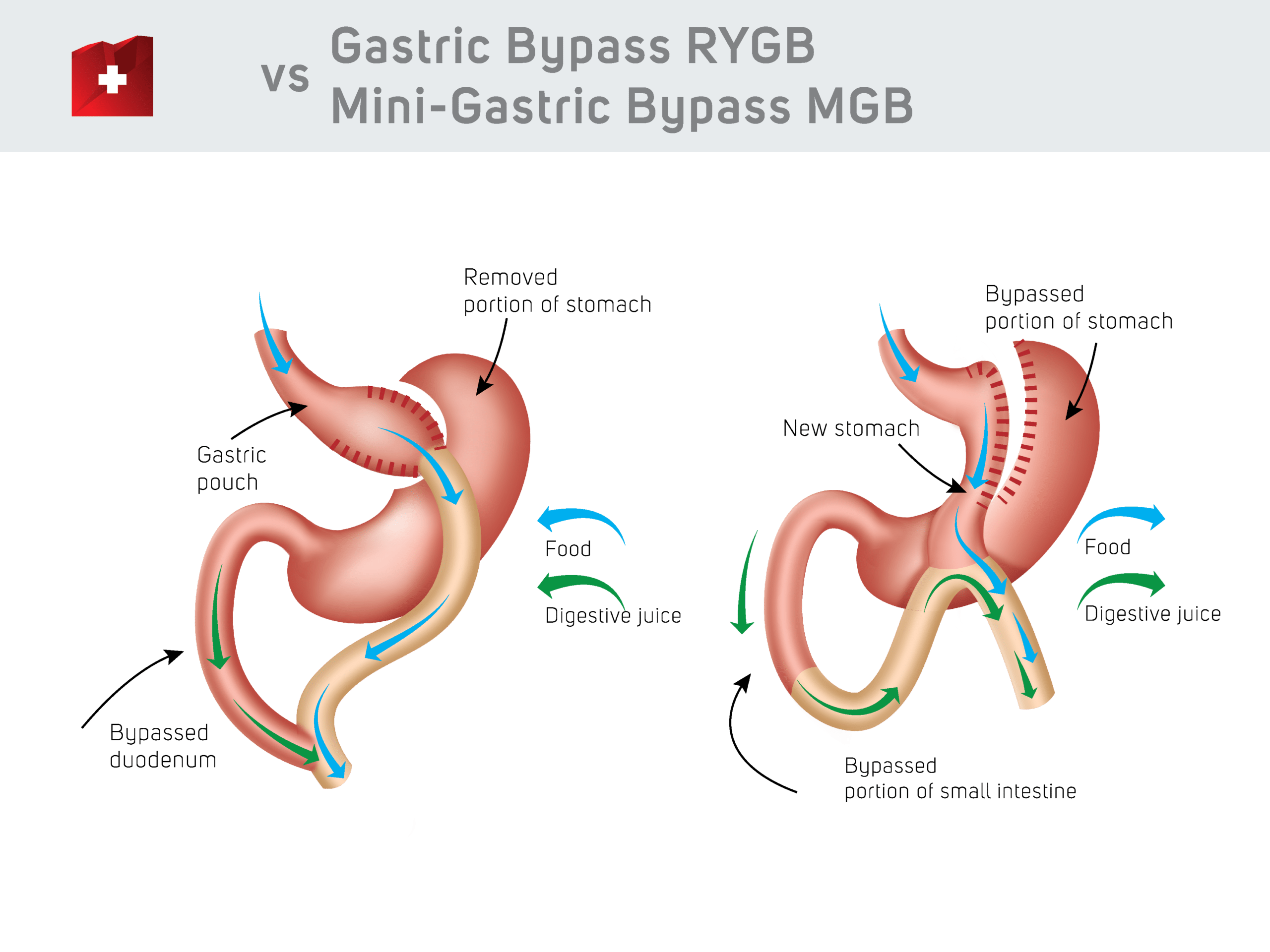 Gastric Bypass vs Mini Gastric Bypass comparasion