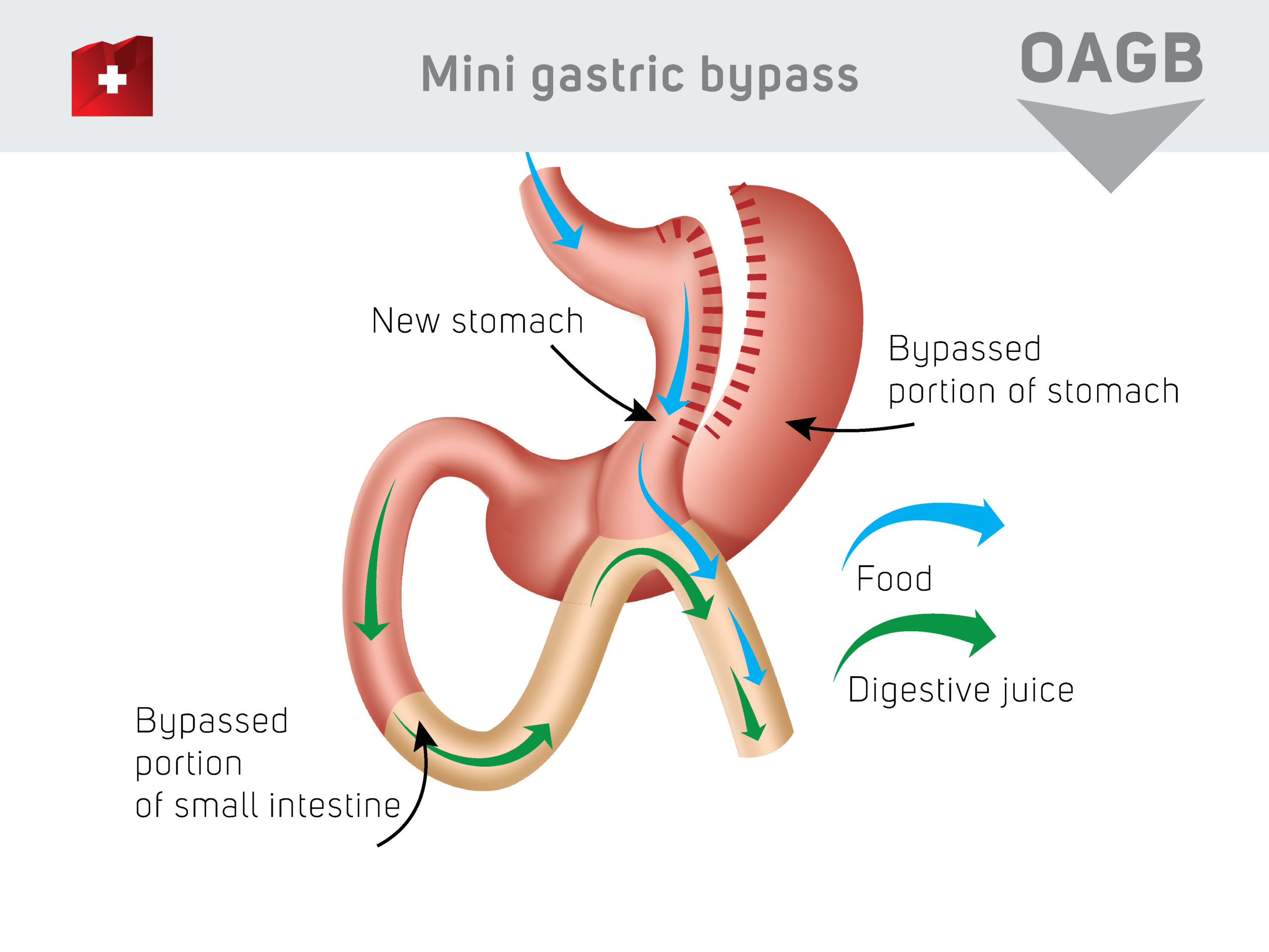 Mini gastric baypass - news stomach / baypassed portion of stomach / baypassed portion of small intestine