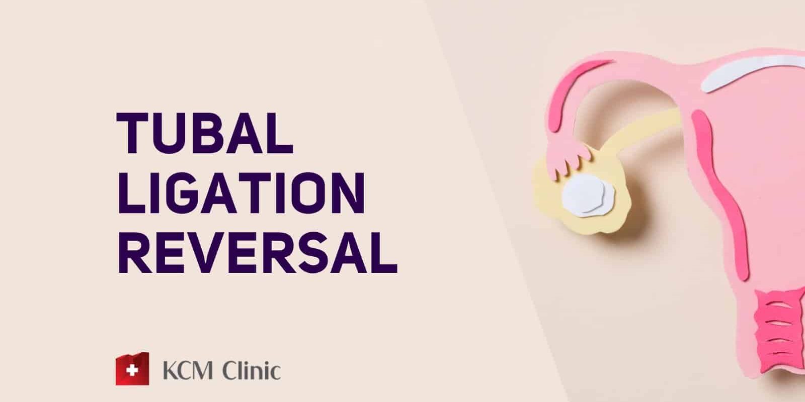 Tubal Ligation Reversal Kcm Clinic