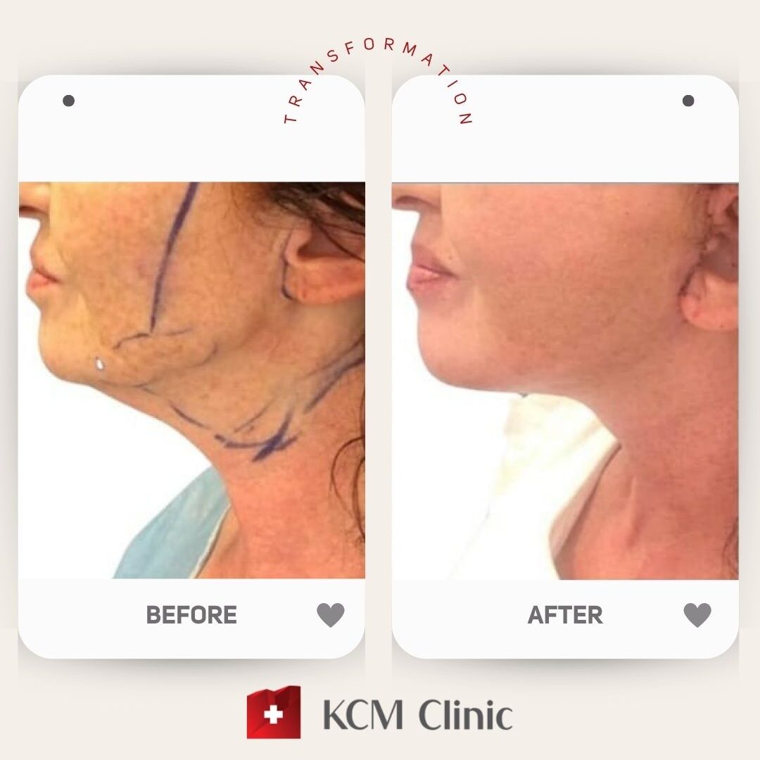 Face and Neck Lifting 
Plastic Surgery 
Operacja Plastyczna 