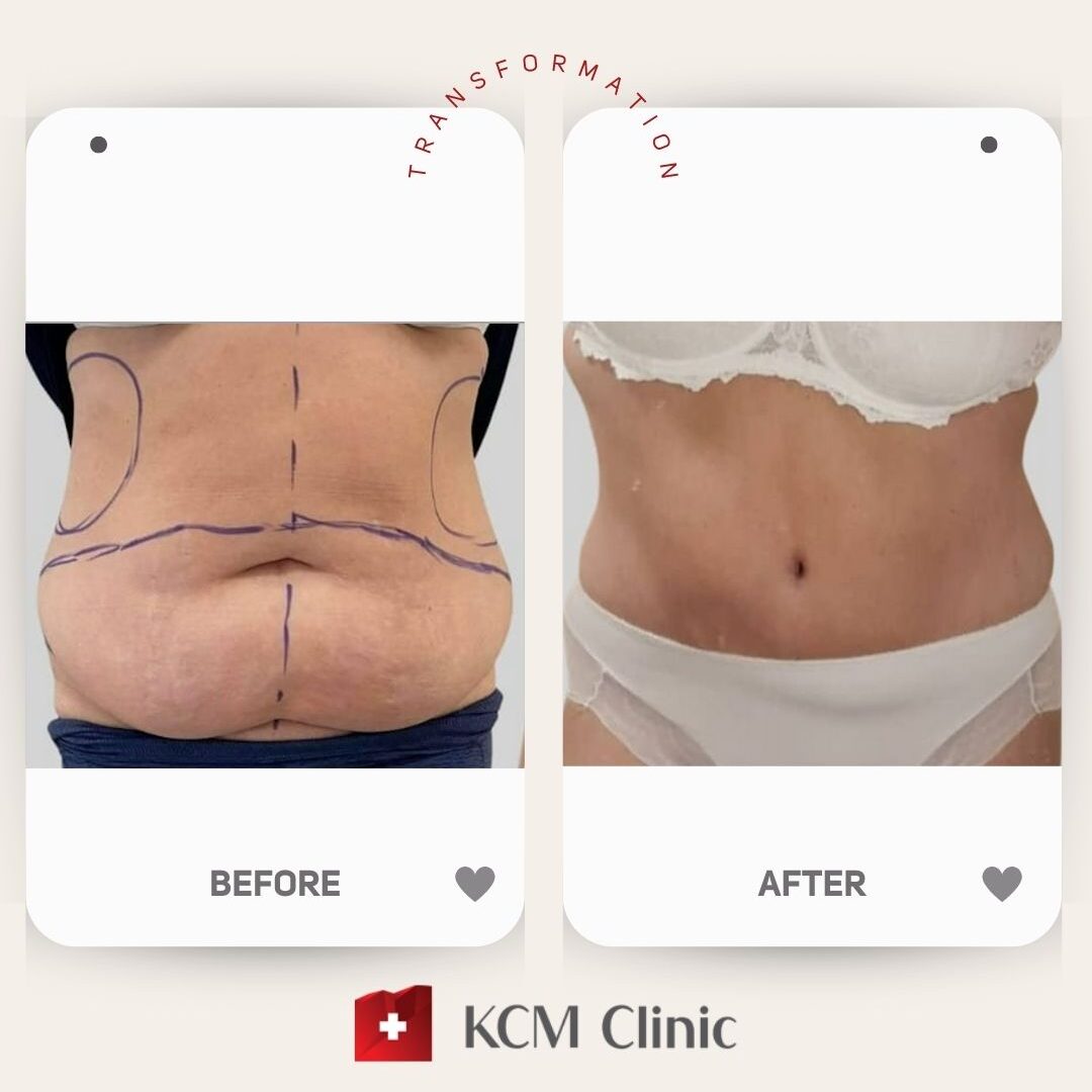 Abdominoplasty with Liposuction
Plastic Surgery
Operacja Plastyczna