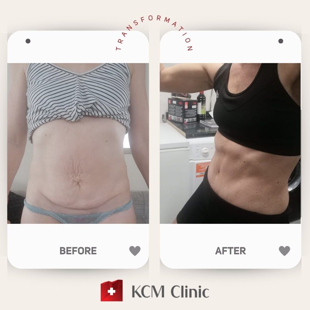 Abdominoplasty with Liposuction
Plastic Surgery 
Operacja Plastyczna