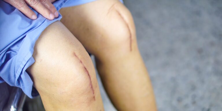 Understanding the Need for Knee Replacement Surgery