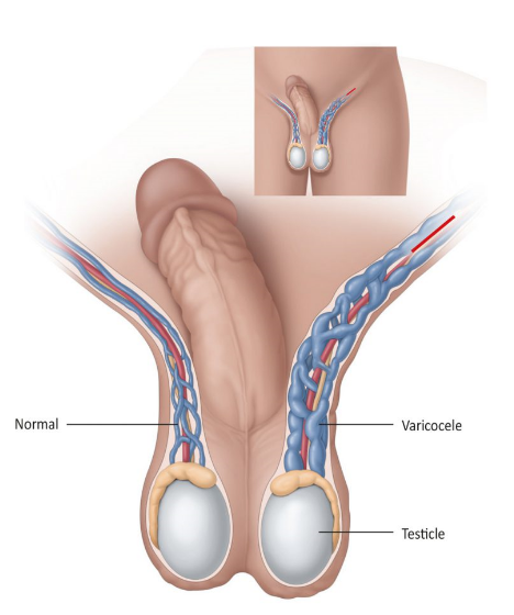 Varicocele Surgery : Symptoms, Causes, Diagnosis & Treatment